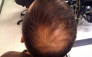 Rụng tóc: Ai? Tại sao? Thế nào?