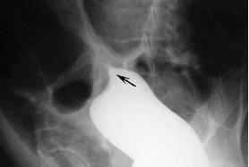 Những điều cần biết về bệnh xoắn đại tràng