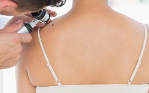 Nốt ruồi nhiều, rủi ro ung thư vú cao hơn