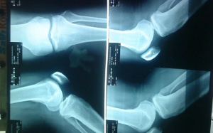 Bệnh viện Chấn thương chỉnh hình phải trả lại tiền 'ăn gian' cho bệnh nhân