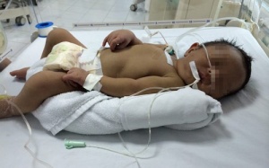 Bất đồng nhóm máu với mẹ, một trẻ sơ sinh suýt chết