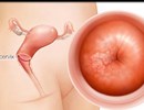 Cách phát hiện sớm bệnh ung thư tử cung