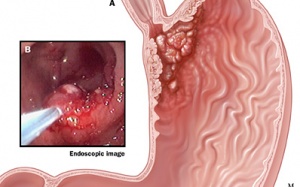 Ung thư dạ dày có phải do loét?