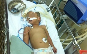 Ngã cầu thang, bé trai 2 tuổi chấn thương sọ não