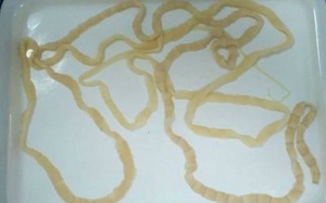 Sán dây 2,5 m sống trong bụng