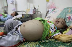 50% người Việt bị nhiễm giun