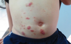 Nguy cơ nhiễm sán chó, mèo