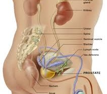 Chẩn đoán ung thư tiền liệt tuyến bằng tinh dịch