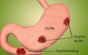 6 điều quan trọng về viêm loét dạ dày ai cũng cần biết