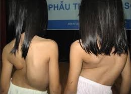 Tìm ra đột biến gen gây gù vẹo cột sống