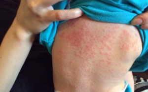 Đã có 146 trẻ em tử vong do dịch sởi