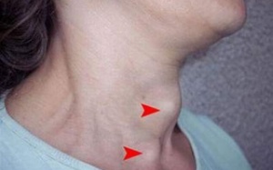 Cần Thơ: Gia tăng các bệnh do thiếu iốt