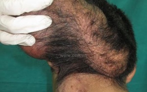 Khối u nặng 1,5kg trên đầu một bệnh nhân