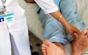 Người lớn có bị bệnh tay chân miệng?