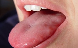 Có phải tôi bị ung thư lưỡi?