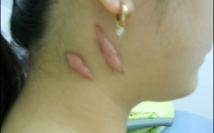 Ðiều trị sẹo lồi thế nào?