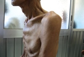 Liên hợp quốc ra kế hoạch xóa bỏ bệnh lao tại hơn 30 quốc gia