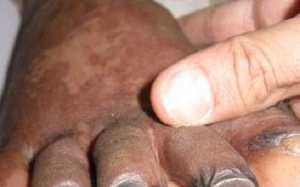 Nhiễm liên cầu khuẩn lợn từ bát tiết canh dê