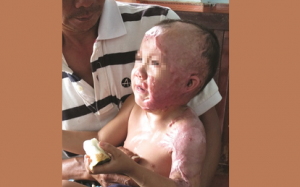 Hạn chế bỏng ở trẻ em