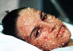 Phát hiện mẫu virus bệnh đậu mùa bị cất giữ trái phép tại Mỹ