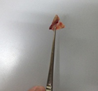 Liên tiếp các ca trẻ nhập viện vì hóc dị vật