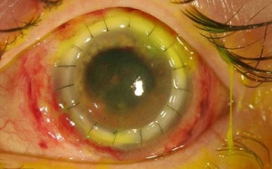 Bị vi khuẩn ăn nhãn cầu vì không vệ sinh kính áp tròng