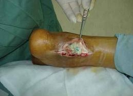 7 trường hợp tử vong vì sử dụng nước bẩn