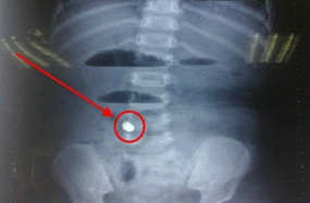 Quảng Bình: Bé trai 3 tuổi nuốt chiếc đinh vít dài 3cm vào trong ổ bụng