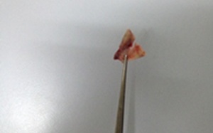 Hóc dị vật ở trẻ: Những điều cha mẹ cần biết