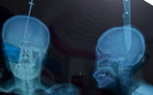 Dao cắm 11cm trên đỉnh đầu vẫn sống