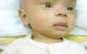 Cứu sống trẻ sơ sinh 18 ngày tuổi bị não úng thủy