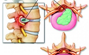 Các dạng biến chứng thoái hóa đốt sống cổ