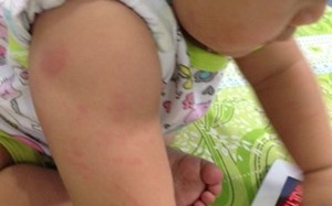 Lại một bé gái nổi mẩn, dị ứng khi dùng sữa Physiolac