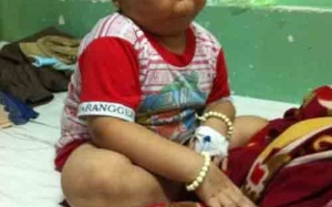 Cháu bé 8 tuổi mắc bệnh xuất huyết tiểu cầu, nát mũi vì phải ăn bằng đường xông