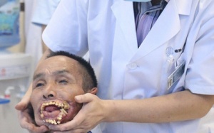 Lần đầu tiên vá mặt cho người đàn ông bị sói cắn mất miệng