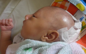 Cứu sống bé 15 ngày tuổi bị khối u thoát vị não