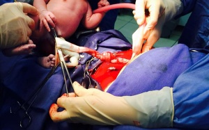 Lào Cai: Cứu sống bé trai bị dây rau thắt nút