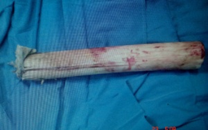 Cứu sống bệnh nhân bị cành cây đâm xuyên lưng, đứt ruột