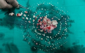 Ấn Độ: Phẫu thuật loại bỏ 232 chiếc răng dư