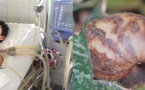 Sự thật về việc ăn ốc sên bị viêm não