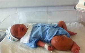 Bé sơ sinh mắc hội chứng dây chằng màng ối hiếm gặp