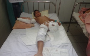 Thừa Thiên Huế: Học sinh tiểu học phải cưa một chân vì tai nạn