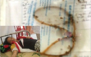 Để quên gạc trong hốc xương má?