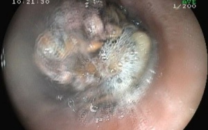 Nghẹn thịt bò mà không hay biết