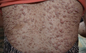 Lạ: Người phụ nữ có mụn thịt mọc khắp người