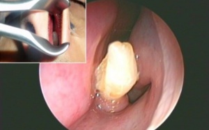 Phát hiện răng mọc trong mũi