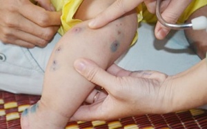 Vĩnh Long: Điều trị thành công tay-chân-miệng