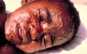 Virus Ebola: Những câu hỏi thường gặp