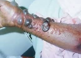 FDA: Cảnh báo nạn rao bán thuốc giả lợi dụng đại dịch Ebola