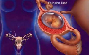 Mang thai ngoài tử cung: Triệu chứng và cách điều trị